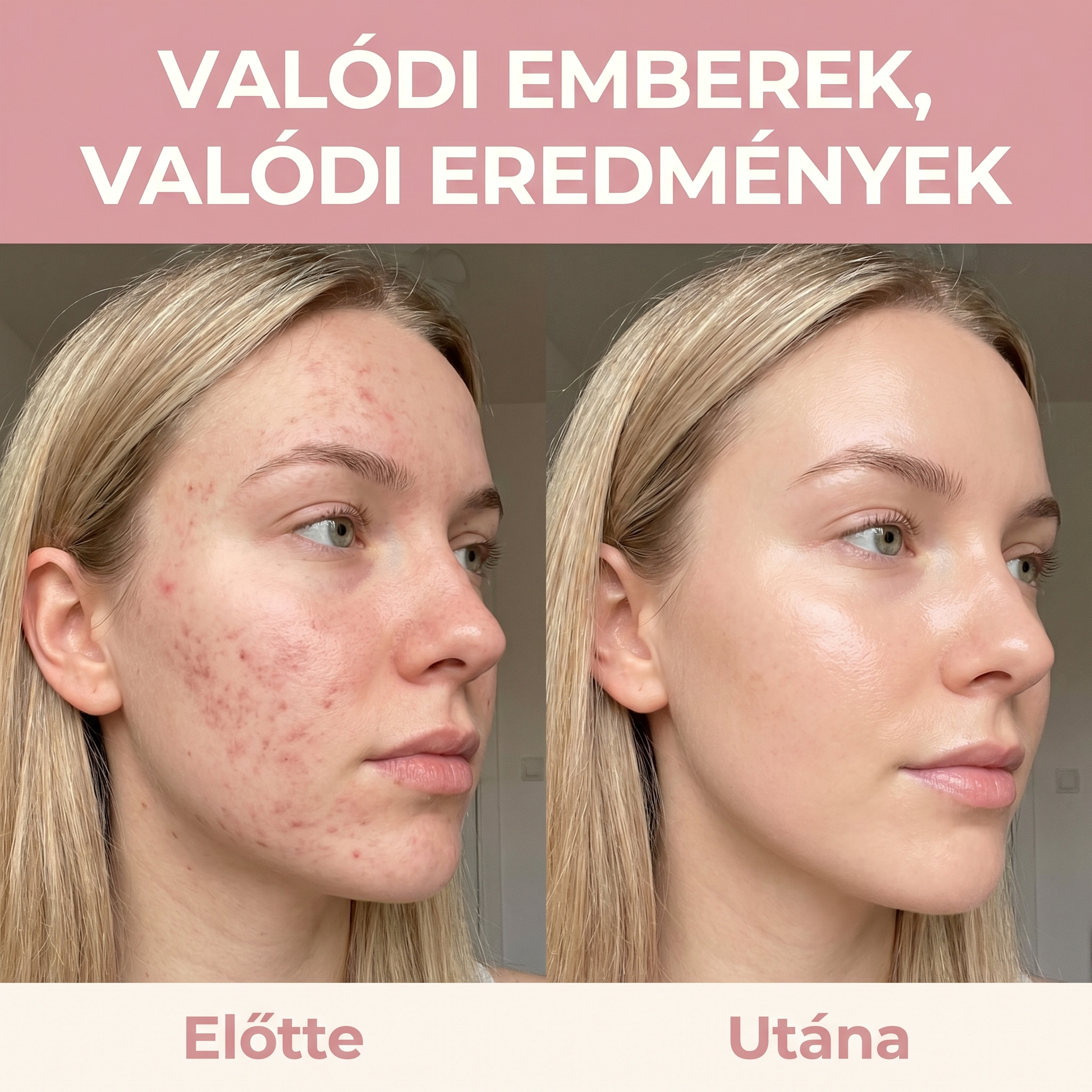 Collagen Harmonia™ bőr hidratáltság előtte utána - ragyogóbb arcbőr kollagén kúra